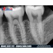 Cảm biến X‑quang nội nha kỹ thuật số Vatech