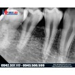 Cảm biến X‑quang nội nha kỹ thuật số Vatech