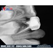 Cảm biến X‑quang nội nha kỹ thuật số Vatech