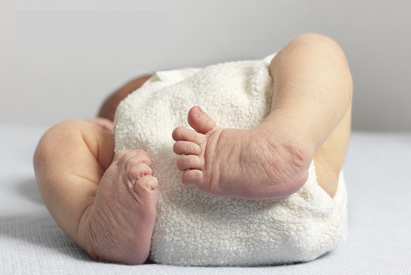 hình ảnh bàn chân khoèo trẻ sơ sinh