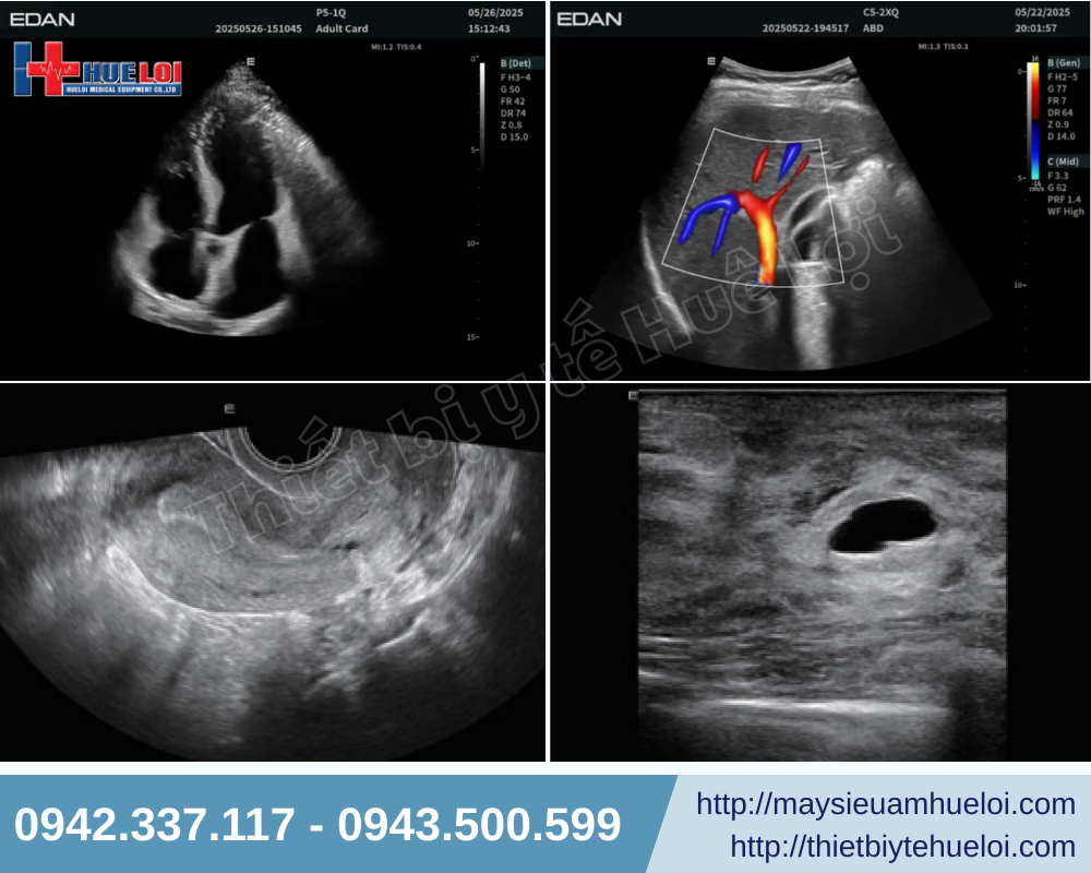 chất lượng hình ảnh siêu âm