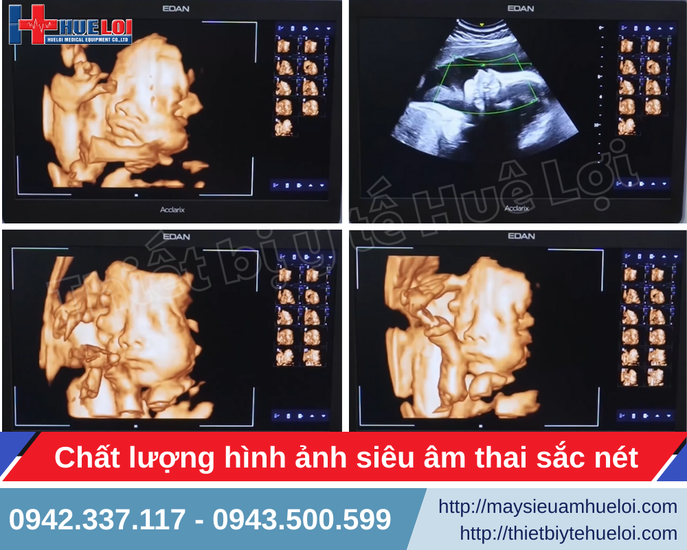 hình ảnh siêu âm thai nhi