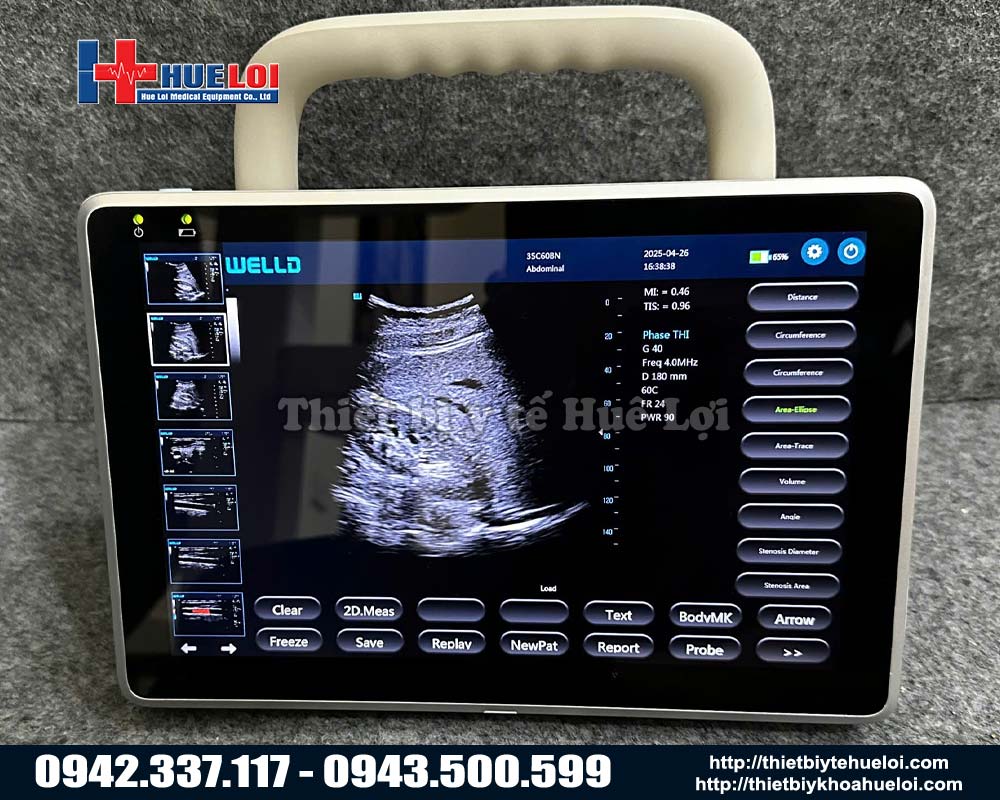 siêu âm doppler màu