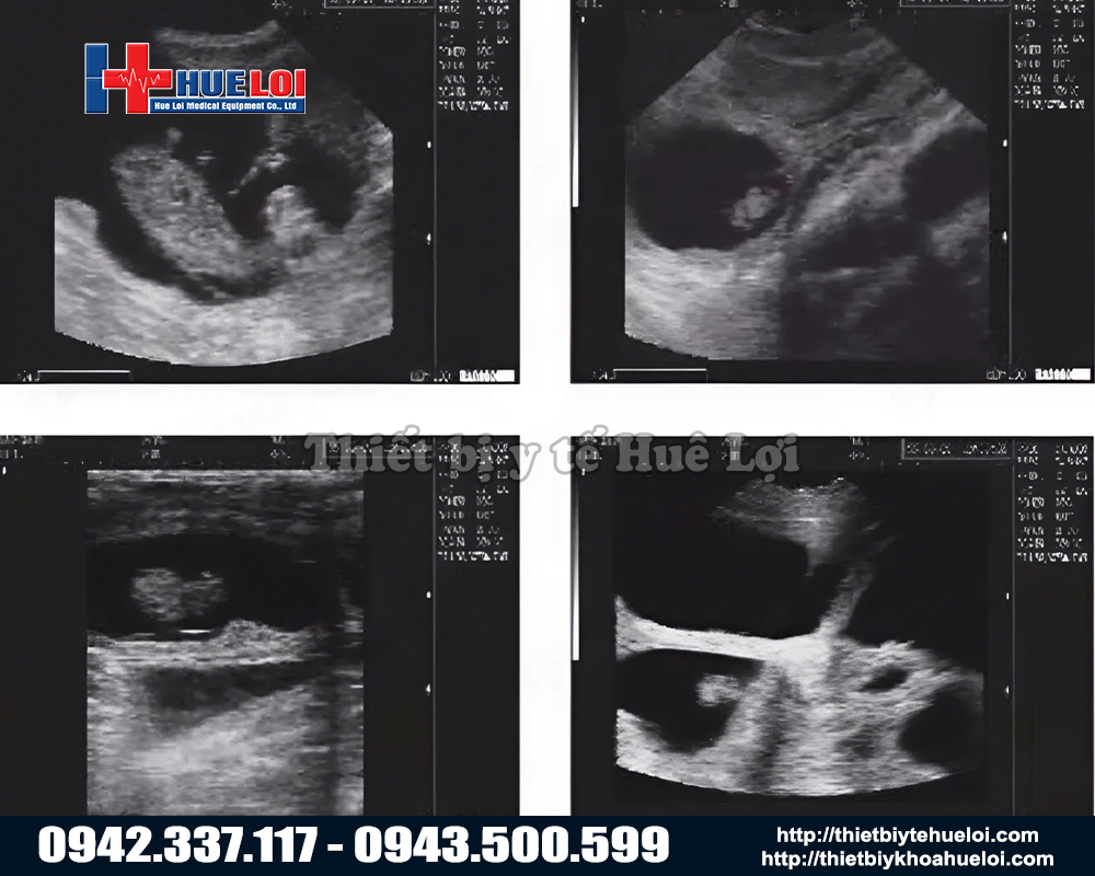 h&igrave;nh ảnh si&ecirc;u &acirc;m